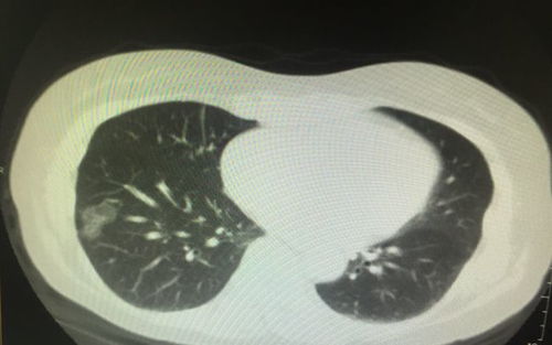 生吃龙爪能治什么病 吃龙爪对肺结节有用吗