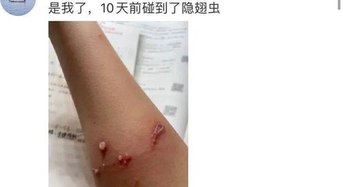 艾灸后虫子都出来了 为什么熏艾会引来虫子