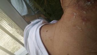 臭虫咬后留下的疤痕怎么消除 臭虫咬的包特点图片