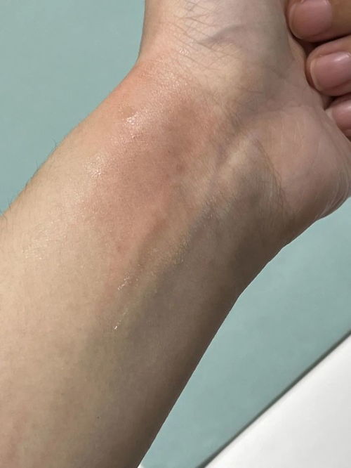 龙爪汁液的功效 龙爪的汁液能直接涂抹伤口吗