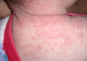 千里光煮水洗澡去湿疹吗 千里光洗澡湿疹加重