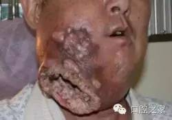 槟榔和橄榄是一个东西吗 橄榄吃了会得口腔癌吗