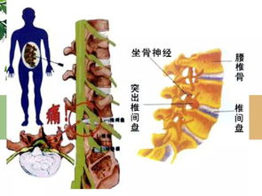 牛筋草熬水泡脚的作用 牛筋草治疗腰椎间盘突出