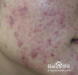 痤疮喝什么茶最排毒 治疗脸上痤疮最好的办法