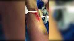 皮开肉绽的样子 皮开肉绽的伤口图片