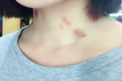 种草莓男生会有反应吗 在胸上种草莓