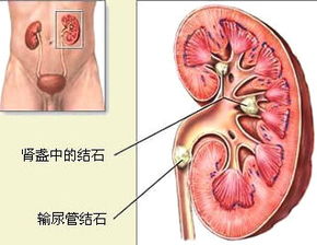 肾结石最怕牛奶 肾结石对人体的危害