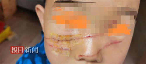 被玫瑰花刺为什么会肿 被花刺扎到的地方肿痛