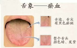 血瘀是寒还是热 什么叫血瘀体质