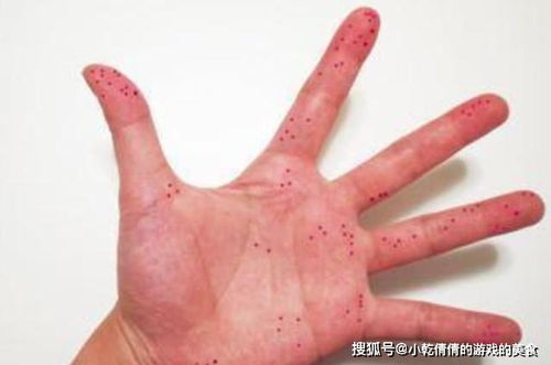 辣椒辣到手了会自愈吗 辣椒辣手属于几级痛